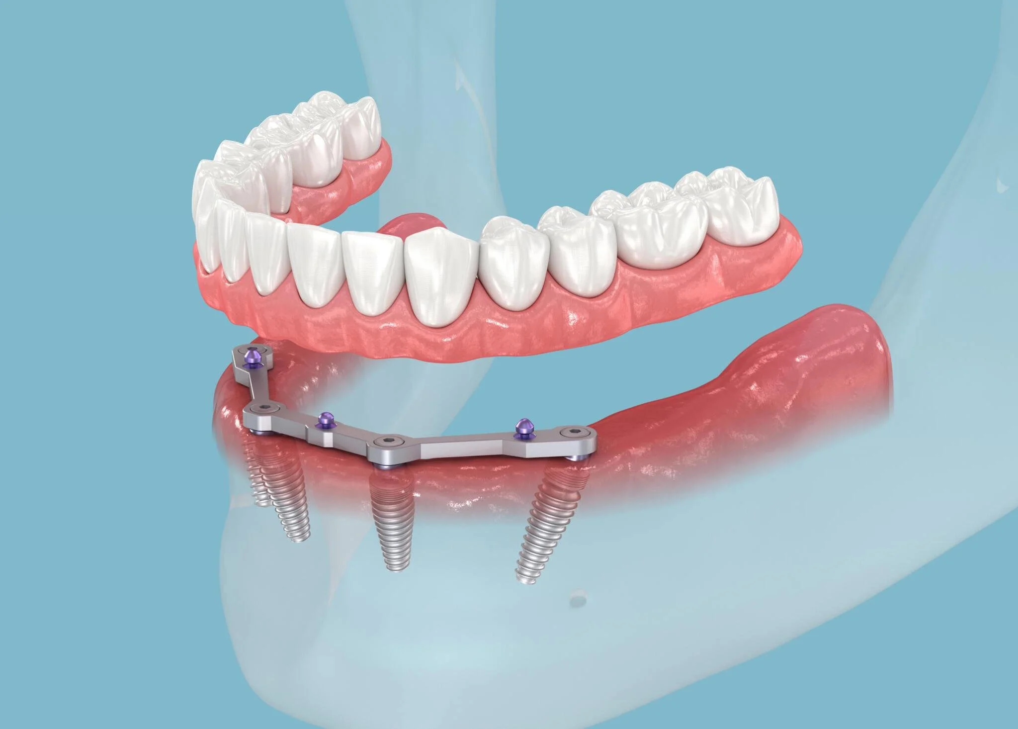 Dental Implant (All on Four) at Apex Dental Care Bhadrak